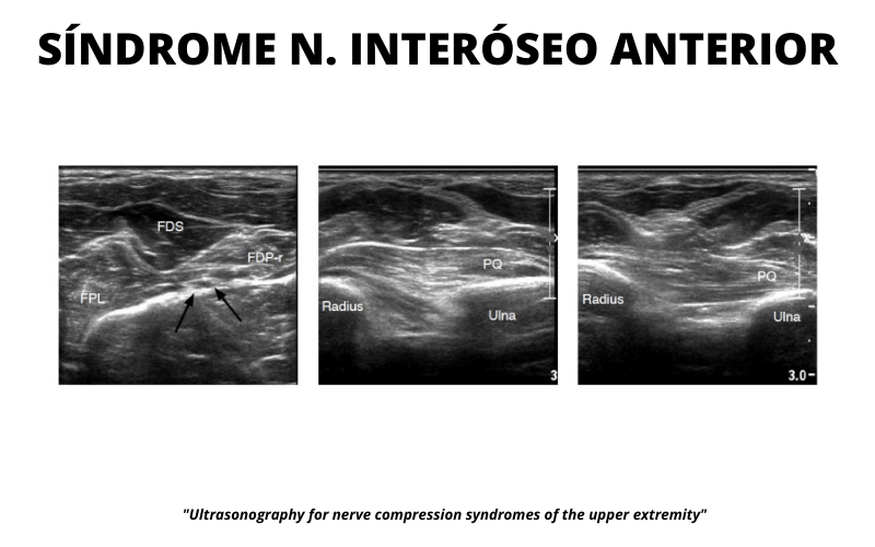 Nervio Interoseo Anterior.png